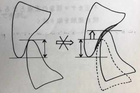 咬合調整の基本原則その3〜バーティカル・ディメンション〜